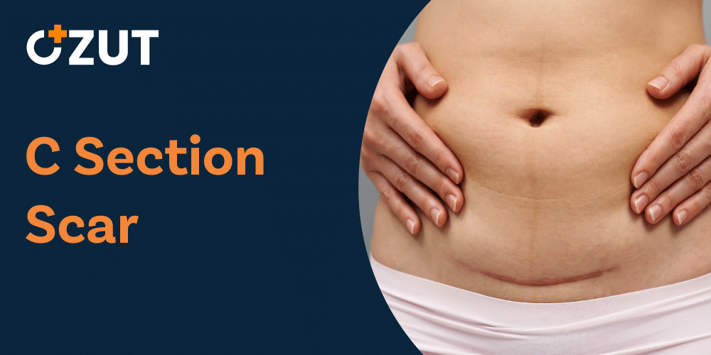 Understanding Cesarean Section Scars: Types, Care, and Minimizing Appearance