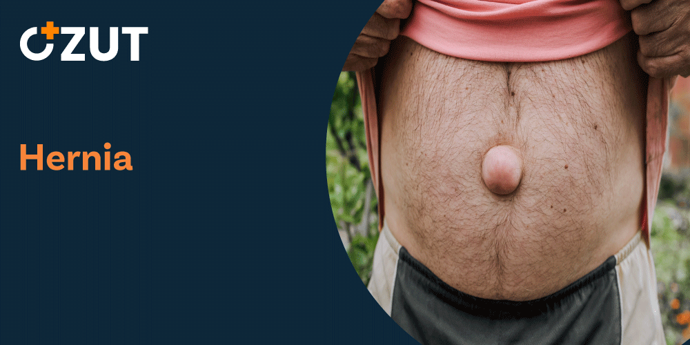 Understanding Hernias: Types, Symptoms, and Treatment Options