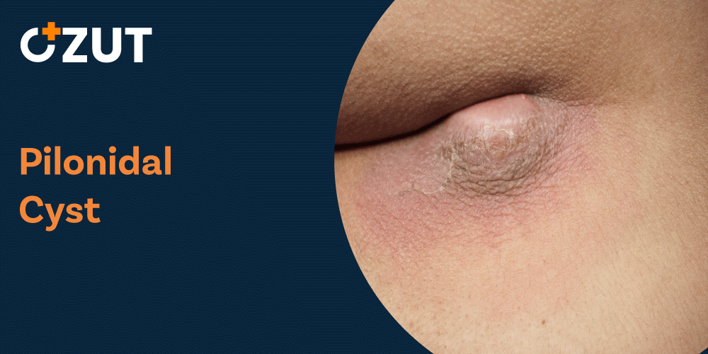 Pilonidal Sinus Infection: Causes, Symptoms, and Treatment Options