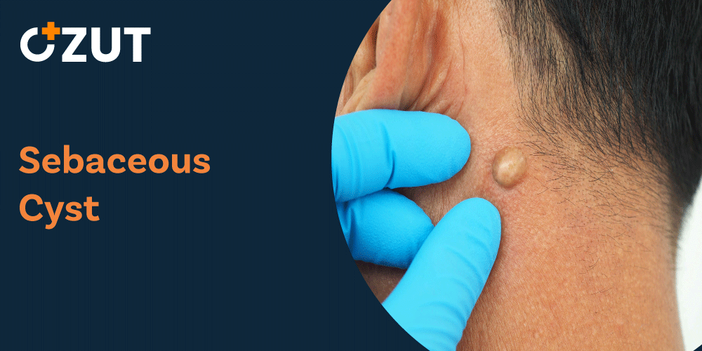 Understanding Sebaceous Cysts: Causes, Symptoms, and Treatment Options