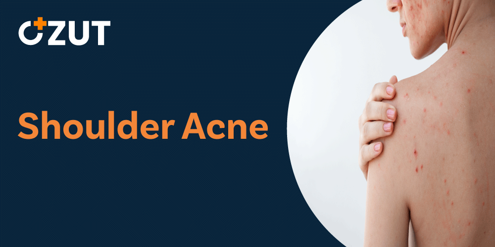 Understanding and Treating Shoulder Acne: Causes, Types, and Effective Solutions