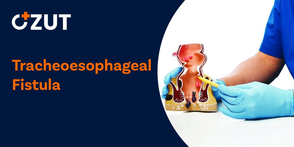 Tracheoesophageal Fistula: Types, Symptoms, Diagnosis, and Treatment Options