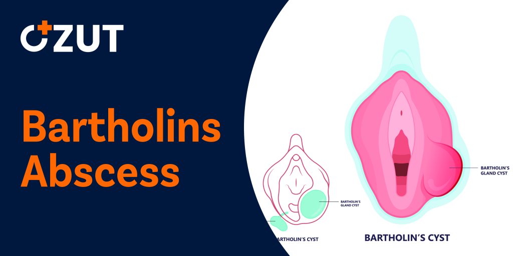 Understanding Bartholin’s Abscess: Causes, Symptoms, Treatment, and Prevention