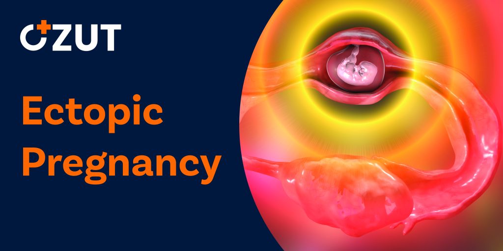 Ectopic Pregnancy: Causes, Symptoms, and Prevention