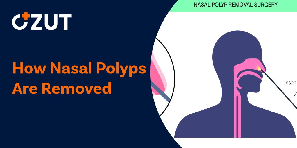 Nasal Polyp Removal: Surgical and Medical Treatment Options