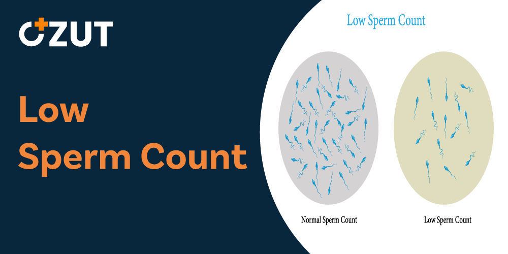 Understanding Low Sperm Count: Causes, Diagnosis, and Treatment Options