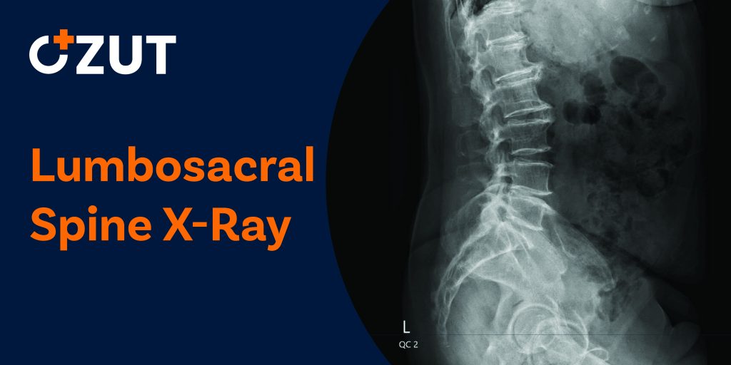 Lumbosacral Spine X-Ray: Purpose, Procedure, and What to Expect