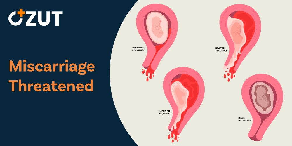 Understanding Threatened Abortion: Causes, Symptoms, and Management During Early Pregnancy