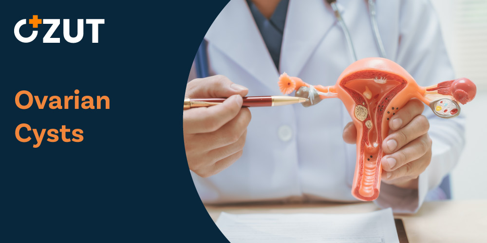 Understanding Ovarian Cysts: Types, Symptoms, and Treatment Options