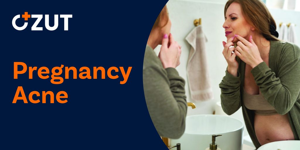 How to Safely Manage Acne During Pregnancy: A Complete Guide