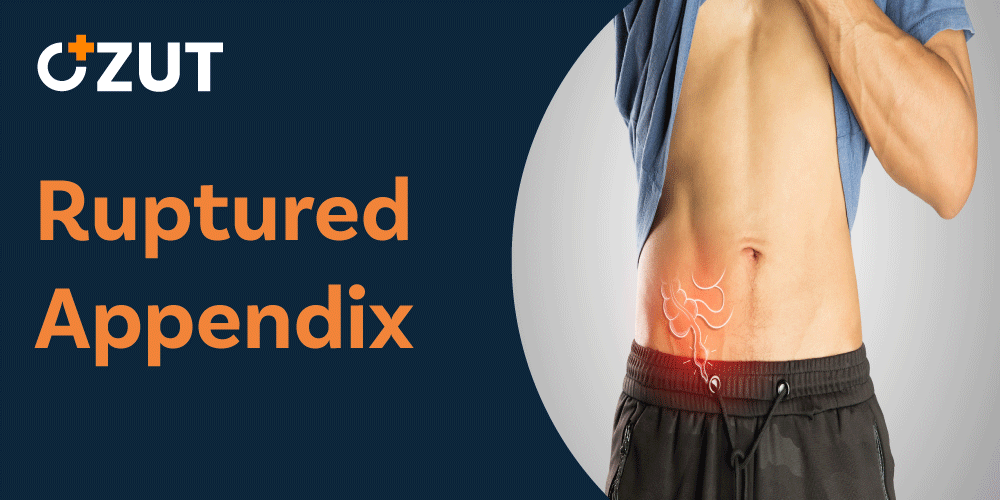 Understanding Appendicitis: Causes, Symptoms, and Complications of a Ruptured Appendix