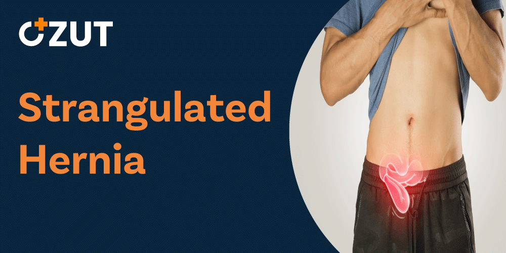 Strangulated Hernia: A Medical Emergency Requiring Immediate Attention