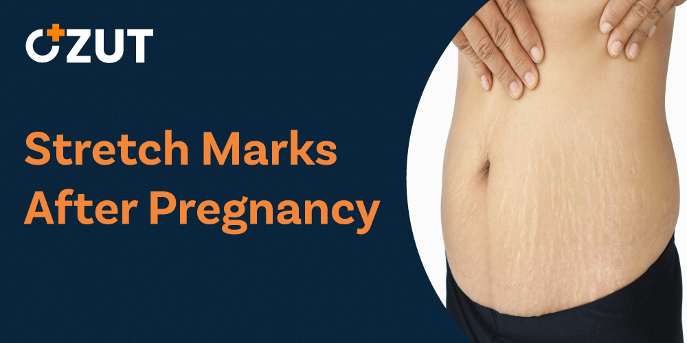 Understanding Stretch Marks During Pregnancy: Causes, Prevention, and Treatment Options