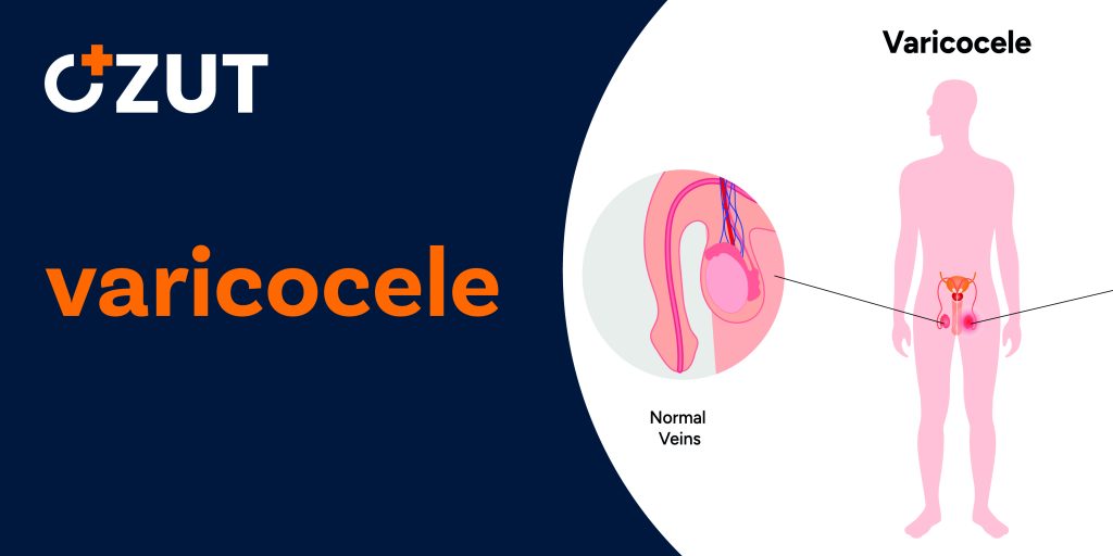 Understanding Varicoceles: Causes, Symptoms, and Treatment Options
