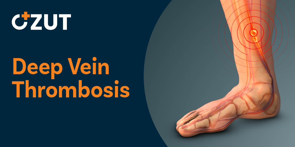 Understanding Deep Vein Thrombosis During Pregnancy: Risks, Symptoms, and Prevention