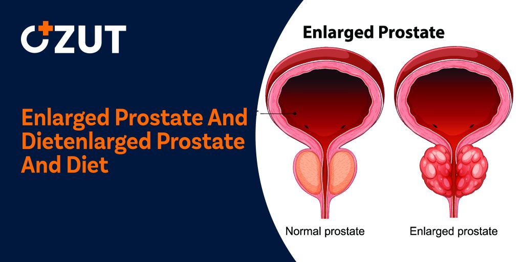 Can Dietary Changes Help Manage Enlarged Prostate Symptoms?