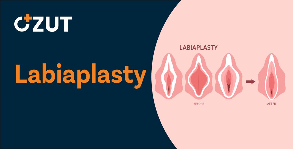 Labiaplasty Surgery: Complete Guide to Procedure, Recovery, and Considerations