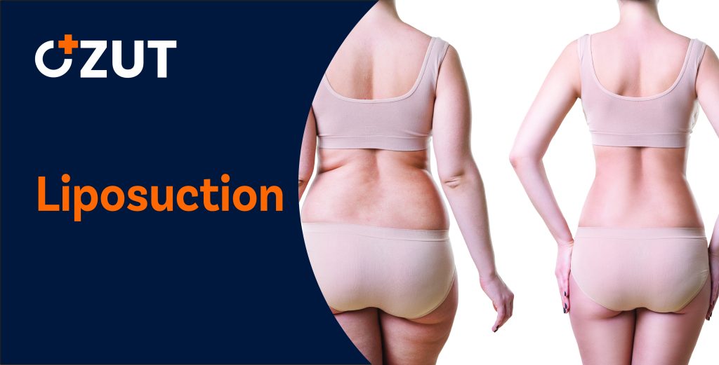 Comprehensive Guide to Body Contouring Fat Removal Procedures: What You Need to Know
