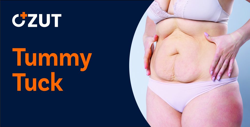 Comprehensive Guide to Abdominoplasty: What You Need to Know About Tummy Tuck Surgery