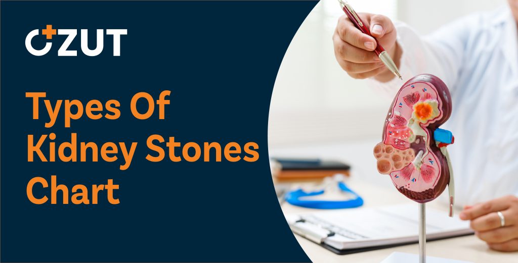 Understanding the Four Main Types of Kidney Stones and How to Prevent Them