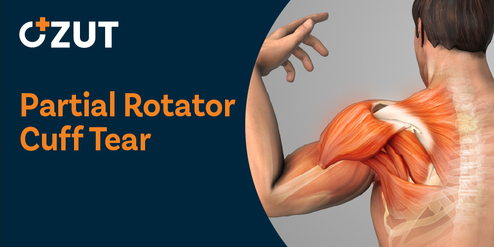 Understanding Partial Rotator Cuff Tears: Causes, Symptoms, and Treatment Options