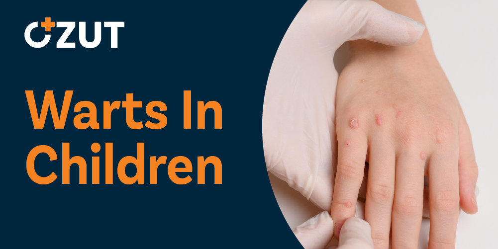 Understanding Skin Warts in Children: Causes, Types, and Treatment Options